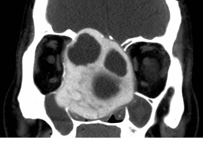 File:Cemento-ossifying fibroma (Radiopaedia 7678-8495 Coronal non-contrast 1).jpg