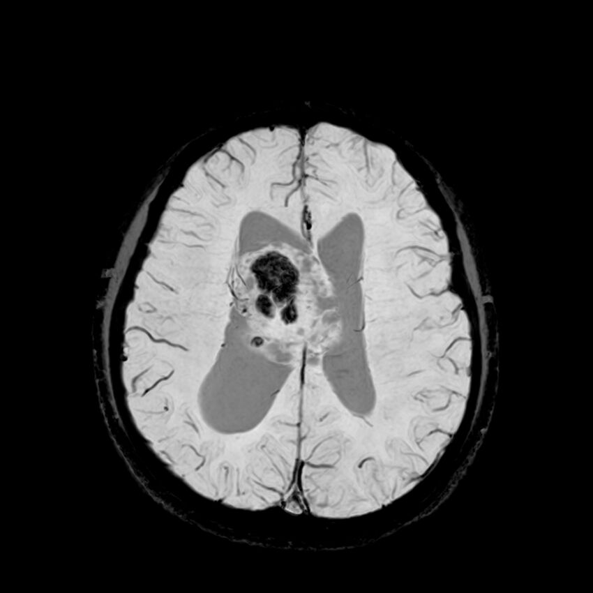 Central neurocytoma (Radiopaedia 79320-92380 Axial SWI 92).jpg
