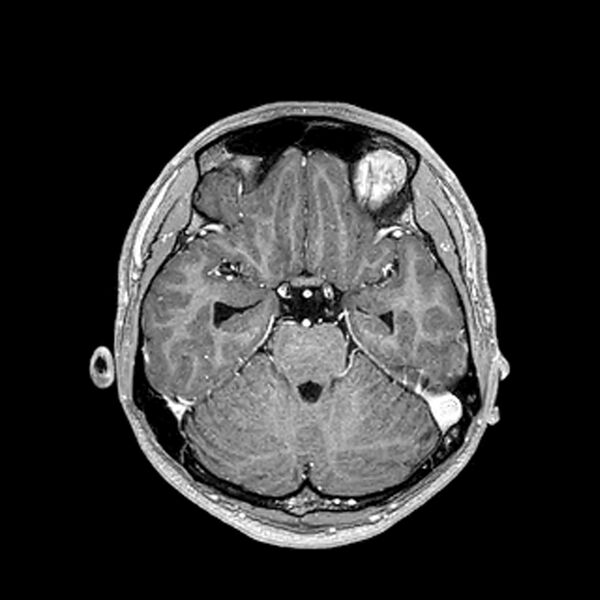 File:Central neurocytoma (Radiopaedia 79320-92380 Axial T1 C+ 93).jpg