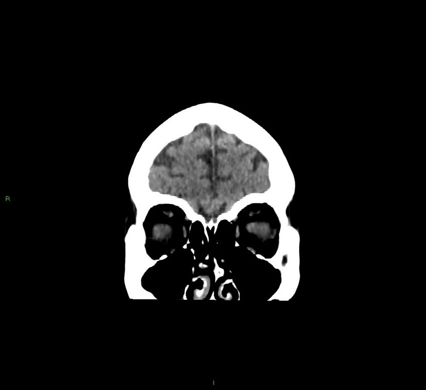 Cerebellar hemorrhage (Radiopaedia 58793-66027 Coronal non-contrast 56).jpg