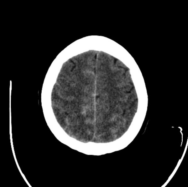 File:Cerebellar hemorrhage causing obstructive hydrocephalus (Radiopaedia 33989-35207 Axial non-contrast 42).jpg