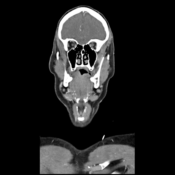 File:Cerebellar infarct due to vertebral artery dissection with posterior fossa decompression (Radiopaedia 82779-97029 D 16).png