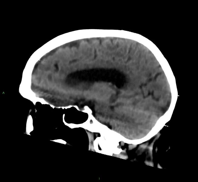 File:Cerebral amyloid angiopathy-associated lobar intracerebral hemorrhage (Radiopaedia 58377-65514 B 29).jpg