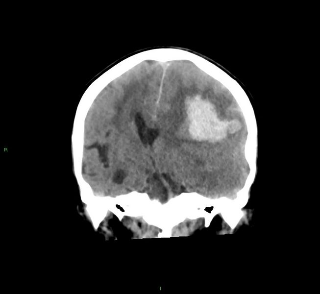 File:Cerebral amyloid angiopathy-associated lobar intracerebral hemorrhage (Radiopaedia 58561-65724 Coronal non-contrast 34).jpg