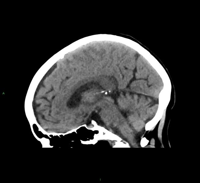 File:Cerebral amyloid angiopathy-associated lobar intracerebral hemorrhage (Radiopaedia 58563-65727 C 29).jpg
