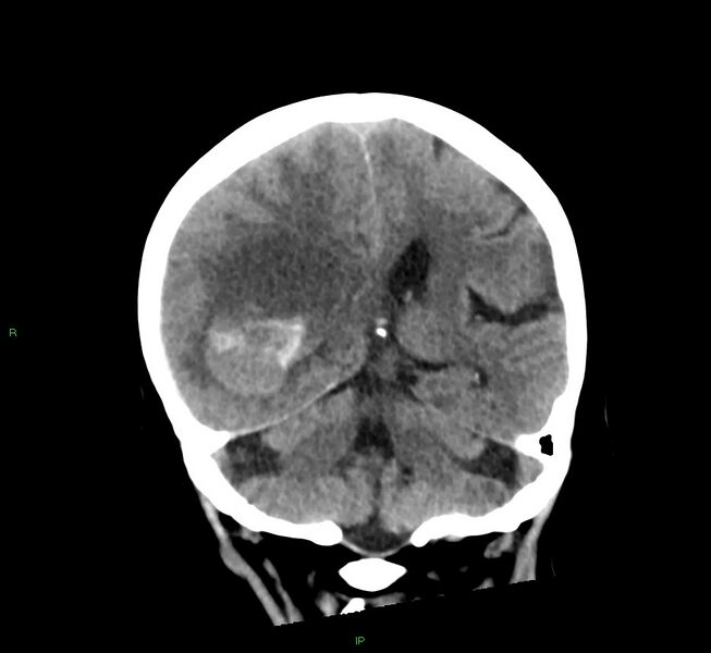 File:Cerebral amyloid angiopathy-associated lobar intracerebral hemorrhage (Radiopaedia 58563-65727 Coronal non-contrast 28).jpg