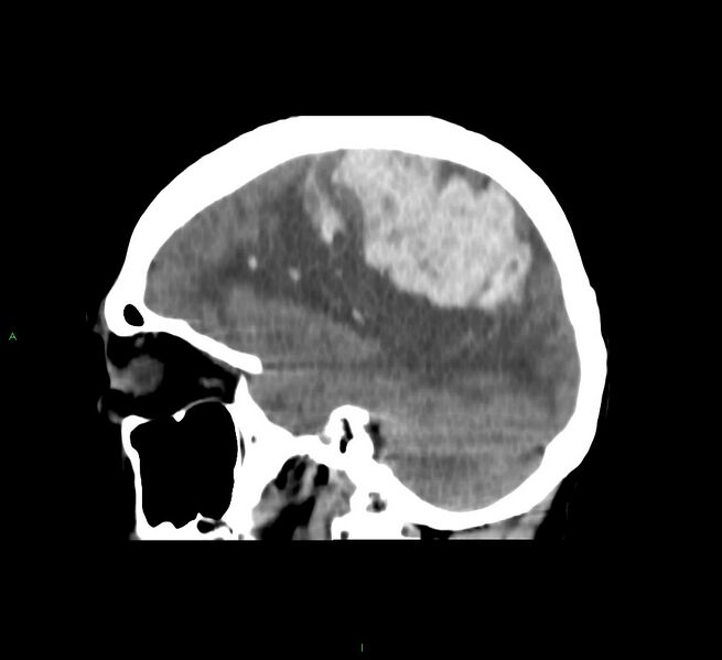 File:Cerebral amyloid angiopathy-associated lobar intracerebral hemorrhage (Radiopaedia 58751-65972 C 21).jpg