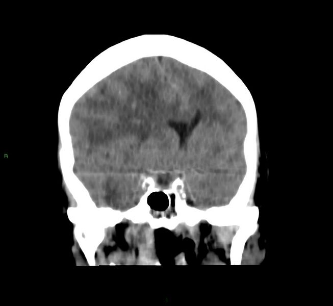 File:Cerebral amyloid angiopathy-associated lobar intracerebral hemorrhage (Radiopaedia 58751-65972 Coronal non-contrast 38).jpg