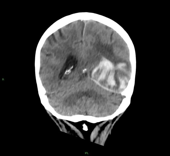 File:Cerebral amyloid angiopathy-associated lobar intracerebral hemorrhage (Radiopaedia 58754-65975 Coronal non-contrast 23).jpg
