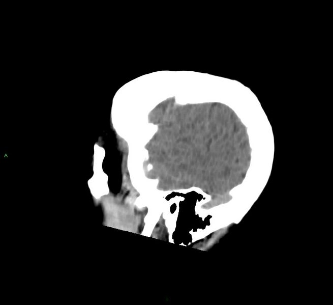 File:Cerebral amyloid angiopathy-associated lobar intracerebral hemorrhage (Radiopaedia 58756-65977 C 49).jpg