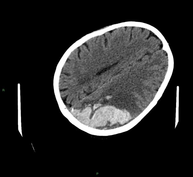 File:Cerebral amyloid angiopathy-associated lobar intracerebral hemorrhage (Radiopaedia 58757-65979 Axial non-contrast 88).jpg