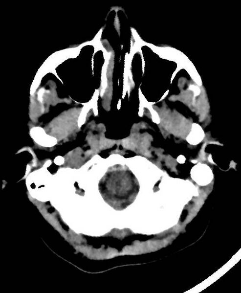 File:Cerebral edema due to severe hyponatremia (Radiopaedia 89826-106937 Axial non-contrast 8).jpg