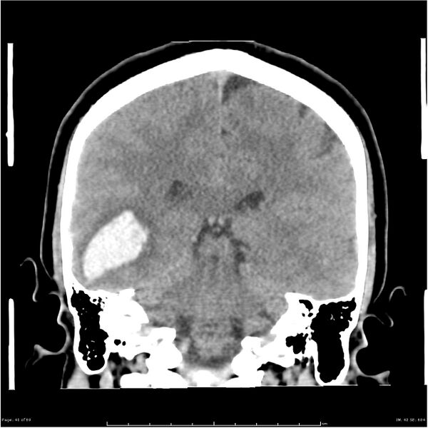 File:Cerebral hemorrhage secondary to arteriovenous malformation (Radiopaedia 33497-34561 Coronal non-contrast 32).jpg
