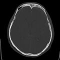 Cerebral hemorrhagic contusions (Radiopaedia 23145-23188 Axial bone window 29).jpg