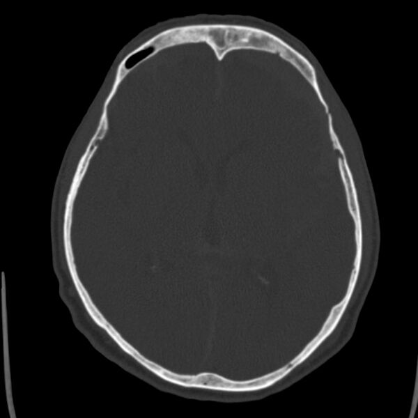 File:Cerebral hemorrhagic contusions (Radiopaedia 23145-23188 Axial bone window 29).jpg