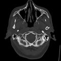Cerebral hemorrhagic contusions (Radiopaedia 23145-23188 Axial bone window 5).jpg