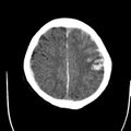 Cerebral hemorrhagic contusions (Radiopaedia 23145-23188 Axial non-contrast 31).jpg