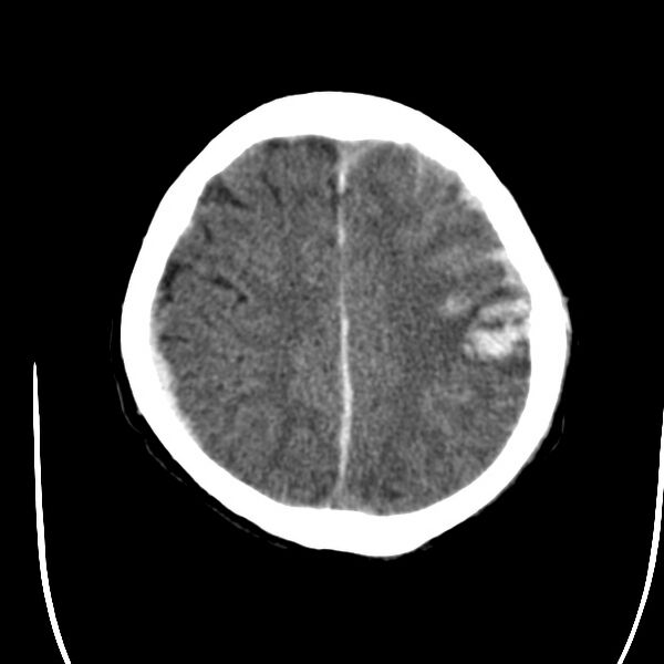 File:Cerebral hemorrhagic contusions (Radiopaedia 23145-23188 Axial non-contrast 31).jpg