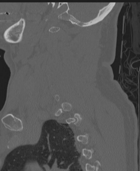File:Cerebral hemorrhagic contusions and cervical spine fractures (Radiopaedia 32865-33841 Sagittal bone window 75).jpg