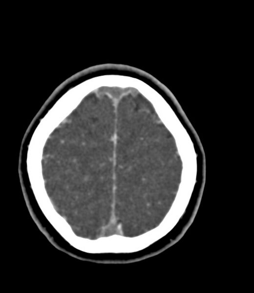 File:Cerebral venous sinus thrombosis (Radiopaedia 59224-66646 Axial C+ delayed 8).jpg