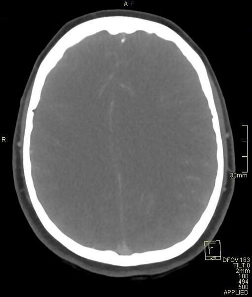 File:Cerebral venous sinus thrombosis (Radiopaedia 91329-108965 Axial venogram 54).jpg