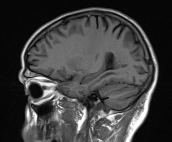File:Cerebral venous thrombosis (Radiopaedia 71207-81504 Sagittal T1 18).jpg