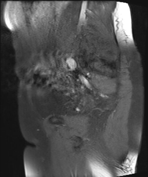 File:Cervical carcinoma (Radiopaedia 88312-104943 Sagittal T1 fat sat 22).jpg