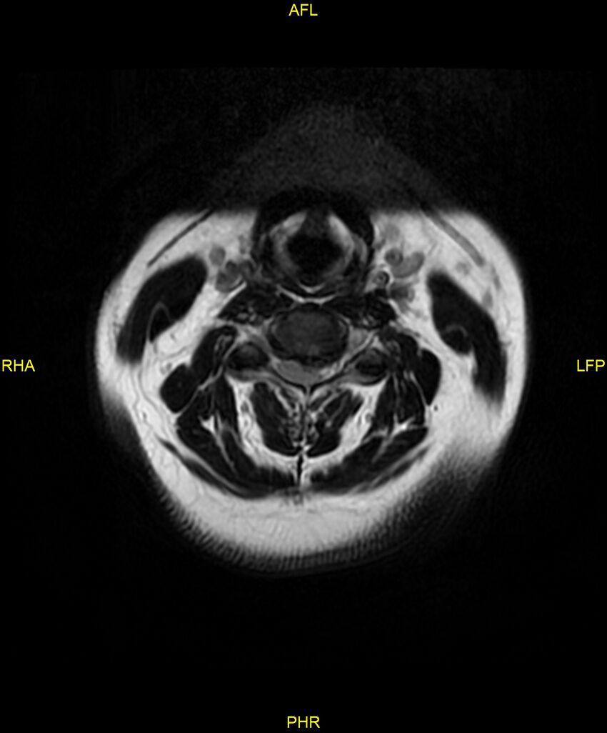 Cervical disc protrusion (Radiopaedia 87147-103415 Axial T2 8).jpg