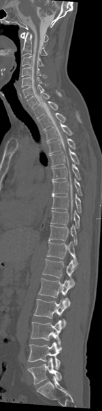 File:Cervical dural CSF leak on MRI and CT treated by blood patch (Radiopaedia 49748-54996 A 5).png
