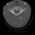 Cervical flexion teardrop fracture with cord hemorrhage (Radiopaedia 32497-33454 Axial bone window 17).jpg
