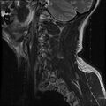Cervical flexion teardrop fracture with cord hemorrhage (Radiopaedia 32497-33455 Sagittal T2 18).jpg