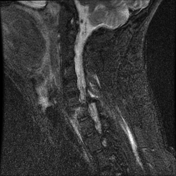 File:Cervical fracture and dislocation with locked facet (Radiopaedia 31837-32781 Sagittal STIR 6).jpg