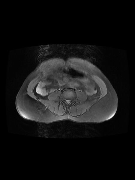 File:Cesarean section scar endometrioma (Radiopaedia 56569-63297 Axial PD fat sat 1).jpg