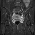 Cesarian section scar endometriosis (Radiopaedia 66520-75799 Coronal STIR 20).jpg