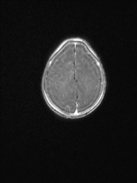 File:Chiari III malformation with occipital encephalocele (Radiopaedia 79446-92559 Axial T1 C+ mpr 70).jpg
