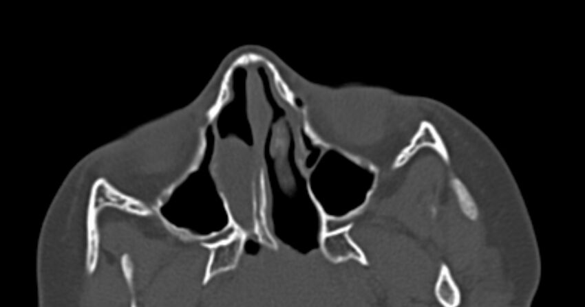 Choanal atresia (Radiopaedia 51295-56972 Axial bone window 27).jpg