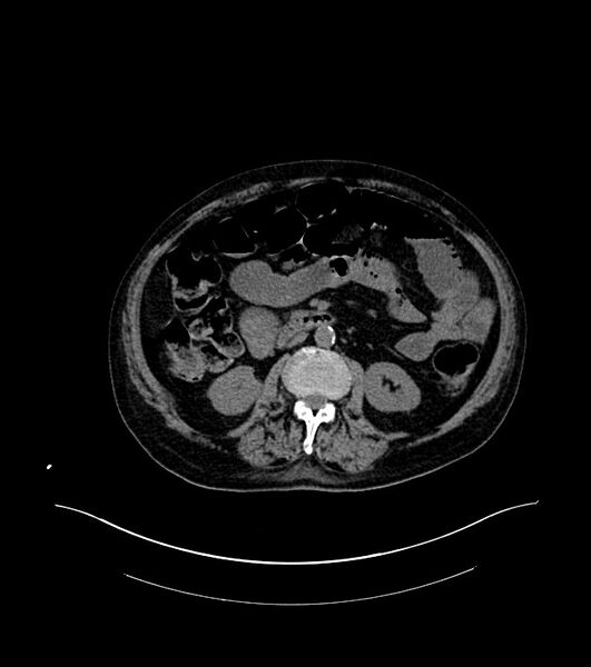 File:Cholangiocarcinoma with cerebral metastases (Radiopaedia 83519-98629 Axial non-contrast 52).jpg