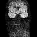 Cholesteatoma (Radiopaedia 10742-11204 Coronal DWI 4).jpg