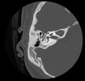 Cholesteatoma (Radiopaedia 20296-20217 bone window 27).jpg