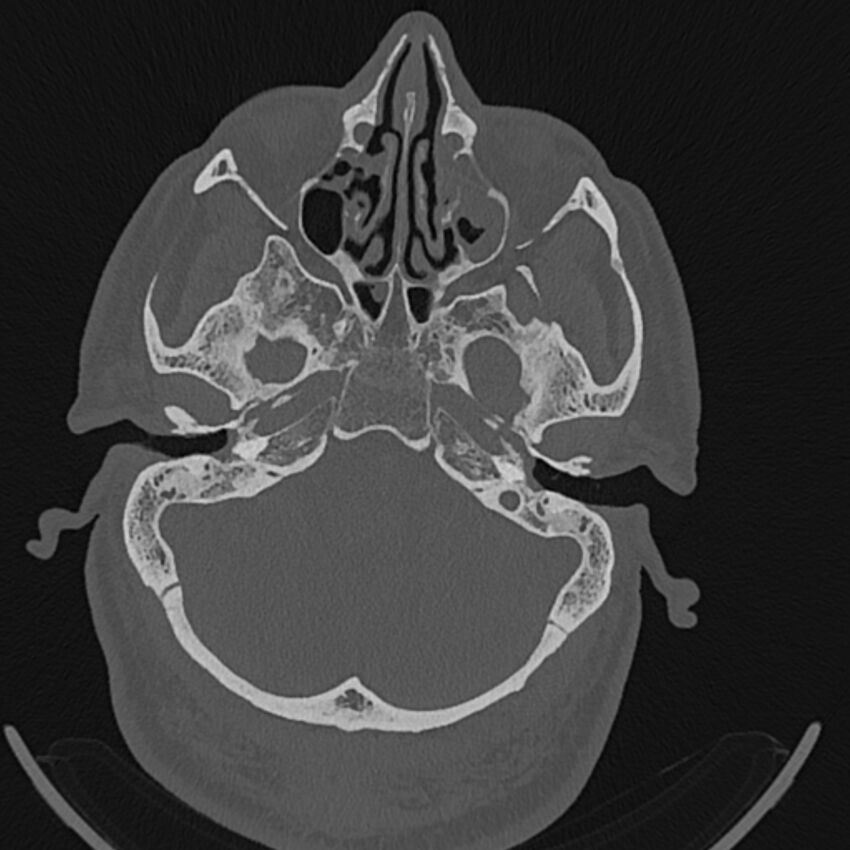 Cholesteatoma (Radiopaedia 68176-77673 Axial bone window 29).jpg
