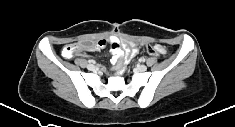 File:Choriocarcinoma liver metastases (Radiopaedia 74768-85766 A 157).jpg