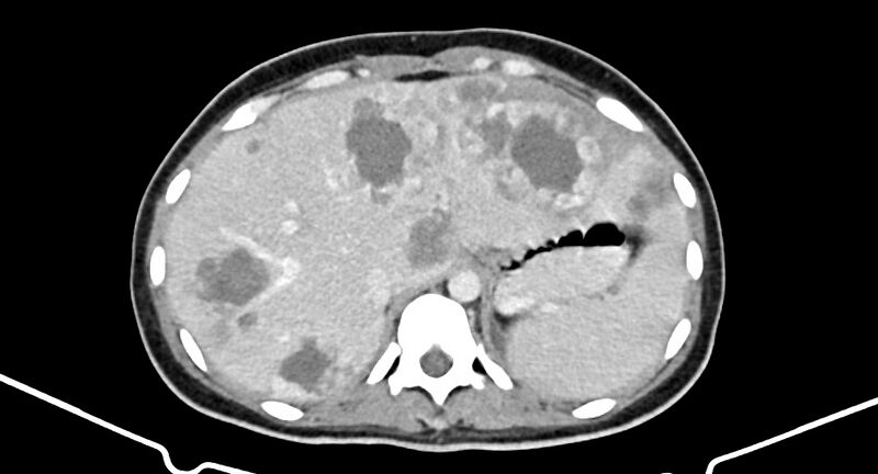 File:Choriocarcinoma liver metastases (Radiopaedia 74768-85766 A 53).jpg