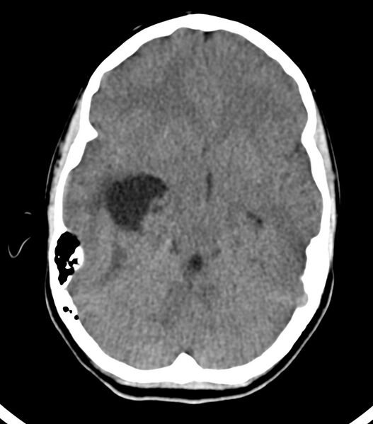 File:Choroid plexus carcinoma (Radiopaedia 91013-108552 Axial non-contrast 24).jpg