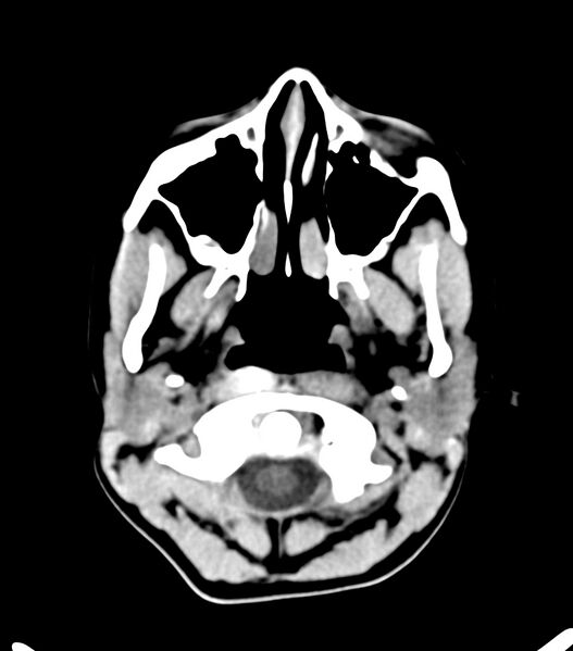 File:Choroid plexus carcinoma (Radiopaedia 91013-108552 Axial non-contrast 4).jpg