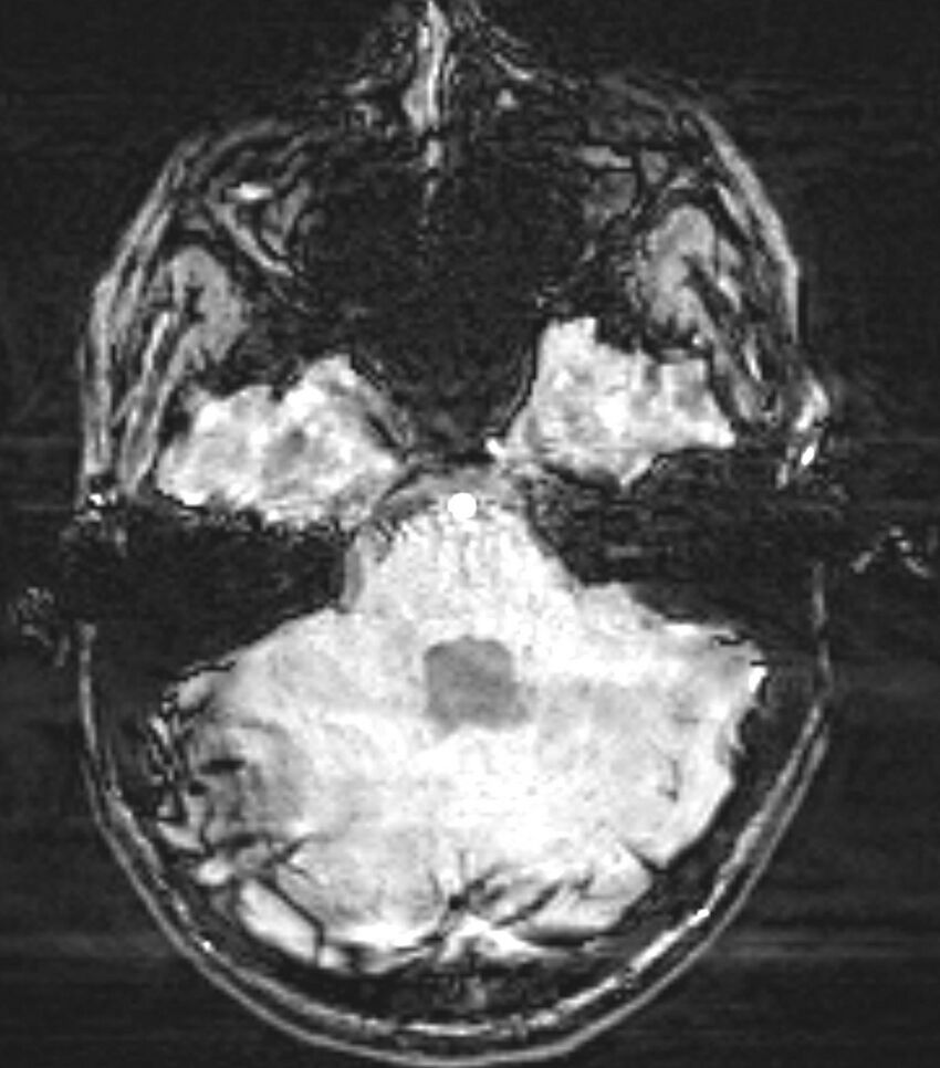 Choroid plexus carcinoma (Radiopaedia 91013-108553 Axial SWI 26).jpg