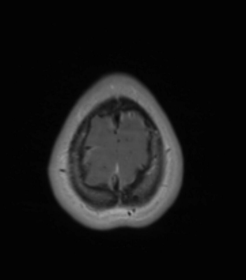 Choroid plexus carcinoma (Radiopaedia 91013-108553 Axial T1 C+ 198).jpg