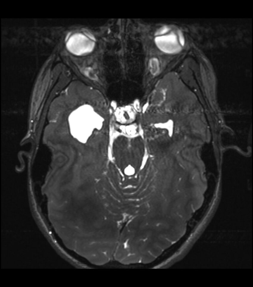 Choroid plexus carcinoma (Radiopaedia 91013-108553 Axial T2 CISS 9).jpg
