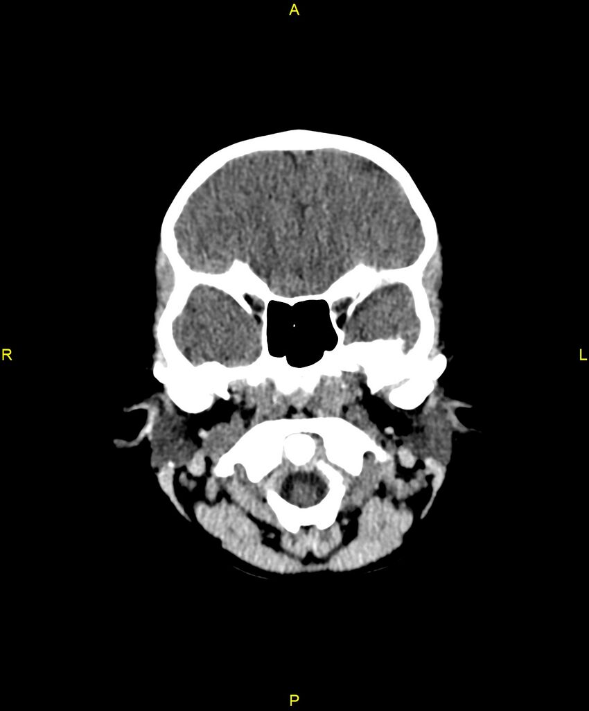 Choroidal fissure cyst (Radiopaedia 89481-106465 Axial non-contrast 24).jpg