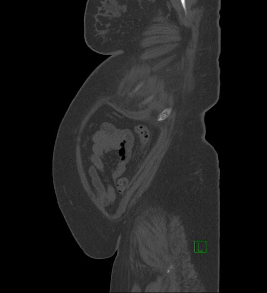 File:Chromophobe renal cell carcinoma (Radiopaedia 84239-99519 Sagittal bone window 8).jpg