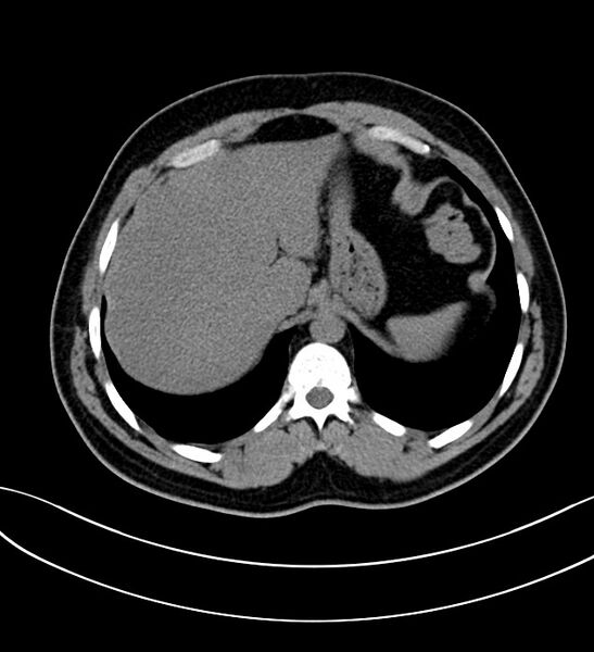 File:Chromophobe renal cell carcinoma (Radiopaedia 84286-99573 Axial non-contrast 3).jpg